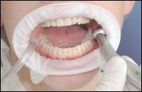 OptraGate Assortment x 80pcs – Ivoclar