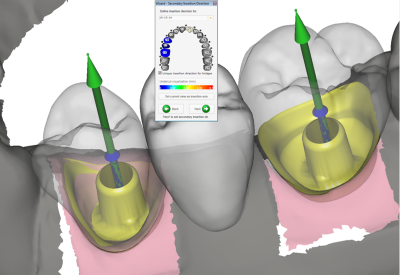 Exocad Basic Software (DentalCAD) – CAD Софтуер за Зъботехнически Лаборатории