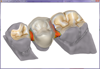 Exocad Basic Software (Exocad DentalCAD)